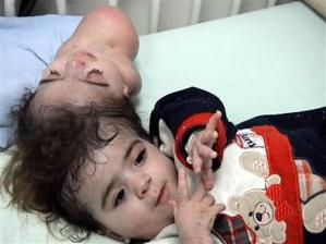 lthumb.xhj10802211747.egypt_separation_surgery_xhj108.jpeg